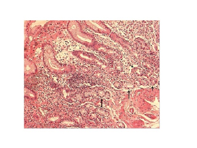 Severe glandular atrophy of the gastric corpus. Presence of few remaining oxyntic glands presenting regressive changes (short arrows), and numerous mucous secreting glands, named PSA (long arrows). HE, original magnification 100× PSA: pseudoantral metaplasia; HE: hematoxylin and eosin.