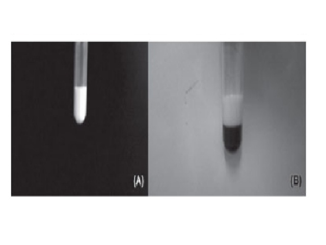 Blood samples showing lipemia A) lipemic serum sample; B) whole blood sample after centrifugation, TG 12,355 mg/dl concentration. TG: triglycerides.