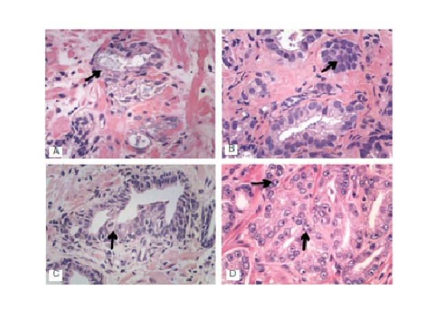 Illustrative images of some morphological criteria for the diagnosis of prostate cancer