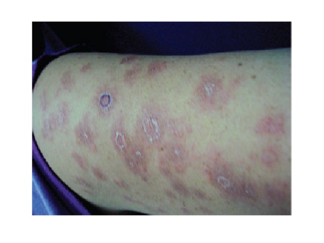 Clinical aspect of patient with metastatic cutaneous Crohn's disease: erythematous scaly plates in left arm