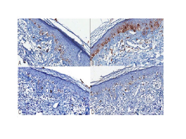 A) numerous isolated cells in the basal layer, in a continuous pattern, labeled with Melan-A, mimicking melanoma in situ; B) S100 stain highlighted junctional melanocytes as well as langerhans cells in the epidermis; C and D) a normal number of melanocytes labeled with HMB45 (C) and tyrosinase (D)