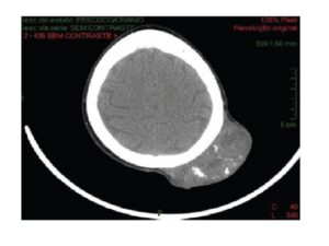 Computed tomography, axial view Hypodense scalp lesion, with calcifications without periosteal invasion, in left parietaltemporal region.