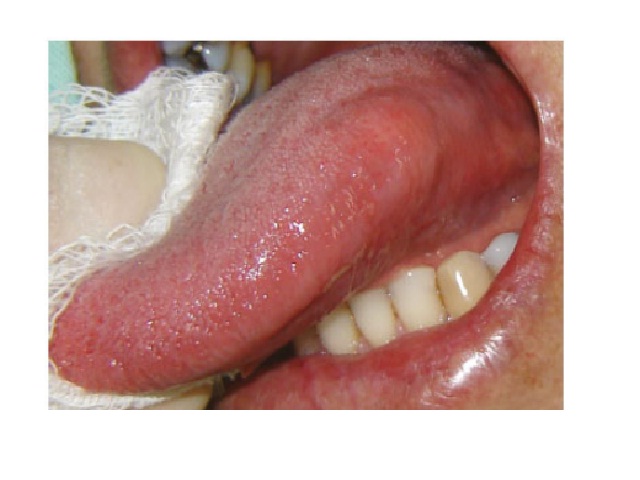 Submucous nodule on the left lateral border of the tongue