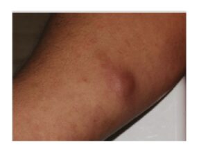 Painless nodular lesion, about 4 cm long on the patient's left arm