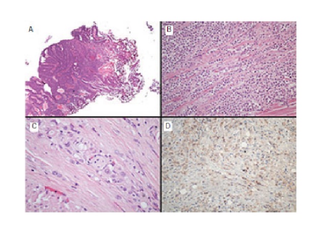 Morphological and immunohistochemical characteristics of the resected specimens A) urothelial papillary neoplasia, HE 20×; B) invasive urothelial carcinoma with discohesive growth pattern, HE 200×; C) tumor cells showed eosinophilic cytoplasm and visible nucleoli, often with intracytoplasmic vacuoles and peripheral nucleus, HE 400×; D) negative for E-cadherin staining, 200×. HE: hematoxylin and eosin.