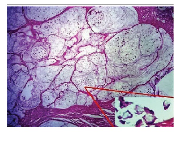 Photomicrograph showing areas with mucinous differentiation in urethral adenocarcinoma (100×). In detail (right and below), neoplastic cells with signet-ring appearance (400×)