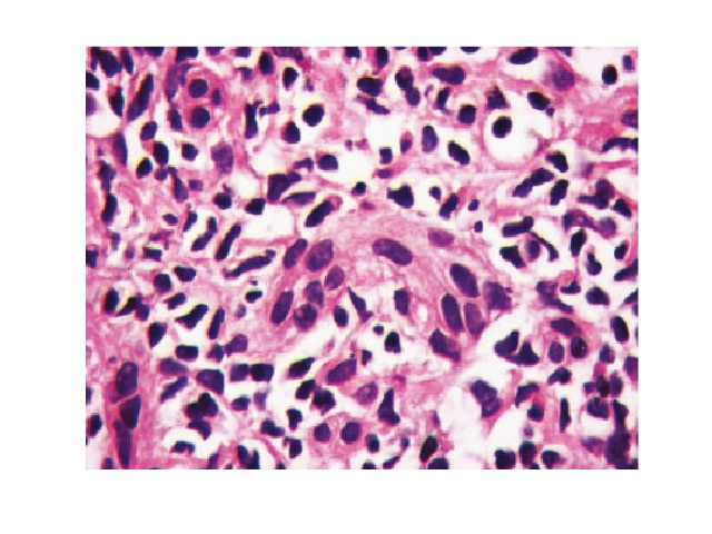 Native liver with chronic hepatitis C: ductal degeneration – cytoplasmic eosinophilia and loss of nuclear polarization (1,000×)