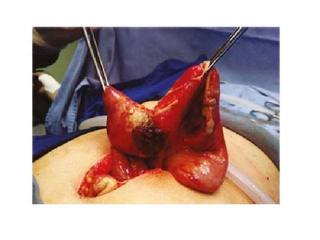 Hemorrhagic lesion, with ill-defined borders and small intestine perforation