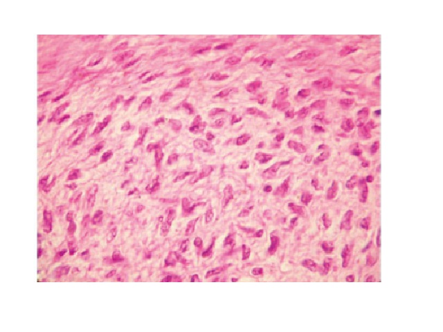 Mild pleomorphism and presence of numerous malignant cells (HE, 400×) HE: hematoxylin and eosin.