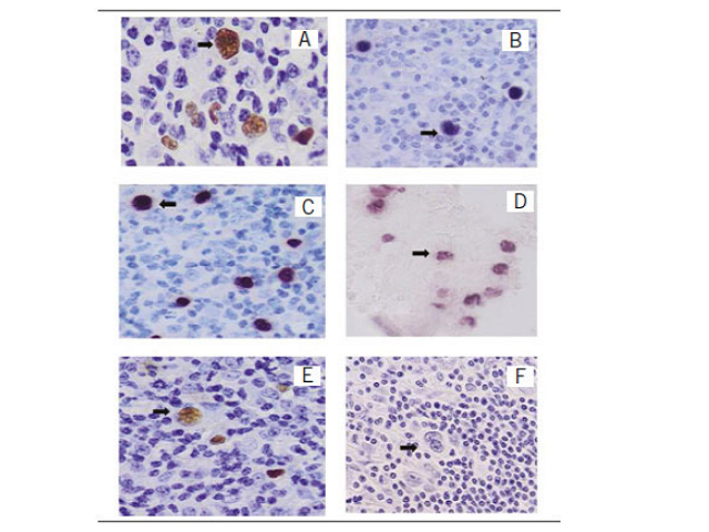 ISH Sample number 30 (lymph node) labeled by the five probes A-E. A-E) positive cells are labeled in brown or purple (bold arrows); F) RNA negative probe. Original magnification 400× from A to F. ISH: in situ hybridization; RNA: ribonucleic acid.