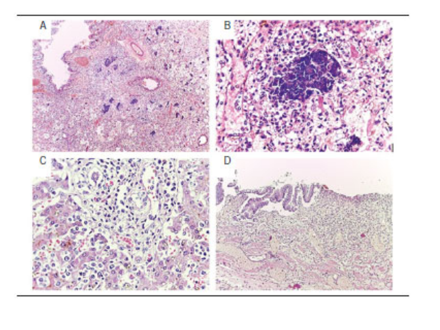 Autopsy findings A) acute pneumonia with bacterial colonies; B) bacterial colony in the lung (highest increase) with suspicious histiocytic aggregates; C) suspected histiocytic aggregates in hepatic parenchyma; D) suspicious histiocytic aggregates in the gallbladder wall.