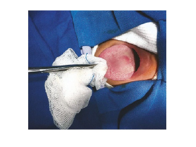 Image of the lesion before the procedure