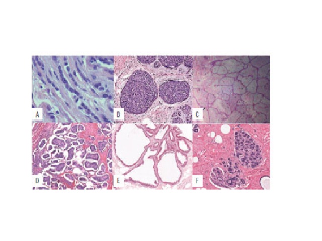 Image model used for the development of the software database A) invasive lobular carcinoma; B) carcinoma in situ; C) fibroadenoma; D) invasive carcinoma of no special type; E) fibrocystic changes; F) normal breast.