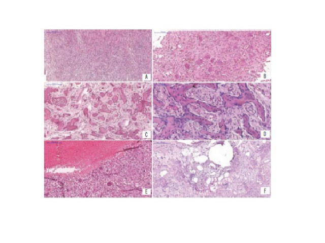 Histopathological aspects A) hypercellularity in JOF; B) presence of multinucleated giant cells; C) psammomatoid pattern; D) osteoid deposition by mesenchymal cells and forming trabecular pattern; E) presence of hemorrhagic areas; F) pseudocystic degeneration present in case 1.