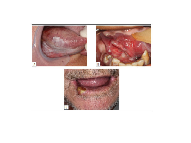 Main sites affected of 80 OSCC cases diagnosed at the ISNF/UFF Oral Pathology Laboratory