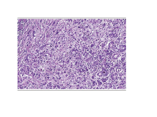 DGC representative area selected for convolutional neural network training with at least 70% of the image, containing DGC DGC: dyscohesive/diffuse gastric carcinoma.