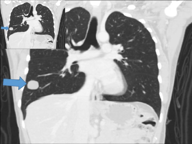 Lung nodule located in lower right lung measuring 2,6 cm on computed tomography scan.