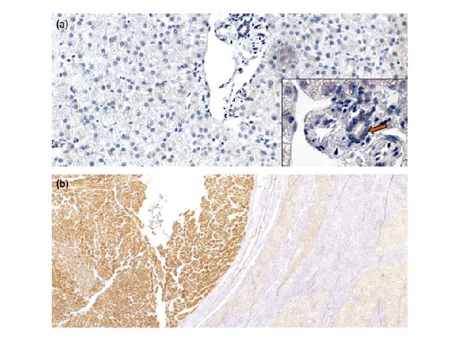 Shh immunoexpression in (a) normal liver, Shh protein is only marked in cholangiocytes (arrow), 200x and 600x magnification; (b) tumoral area (left, strong marking) with pseudoacinar architecture and adjacent cirrhotic nodules (right, moderate marking), 40x magnification.