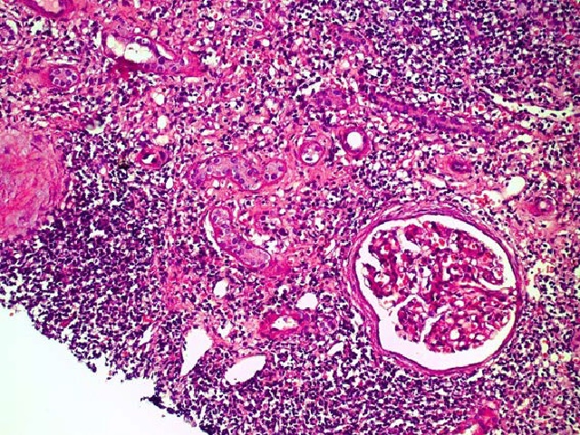 Interstitial lymphomononuclear infiltrate not accompanied by edema and significant tubulitis (dissociation between interstitial and tubular components). Associated tubular atrophy. There is a predominance of small lymphocytes. HE, 100X.